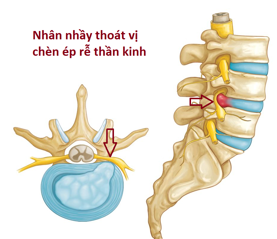 THOÁT VỊ ĐĨA ĐỆM CỘT SỐNG THẮT LƯNG: Nguyên nhân, dấu hiệu nhận biết và khi nào cần đi khám bác sĩ ?